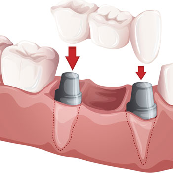 Illustrator of dental bridges
